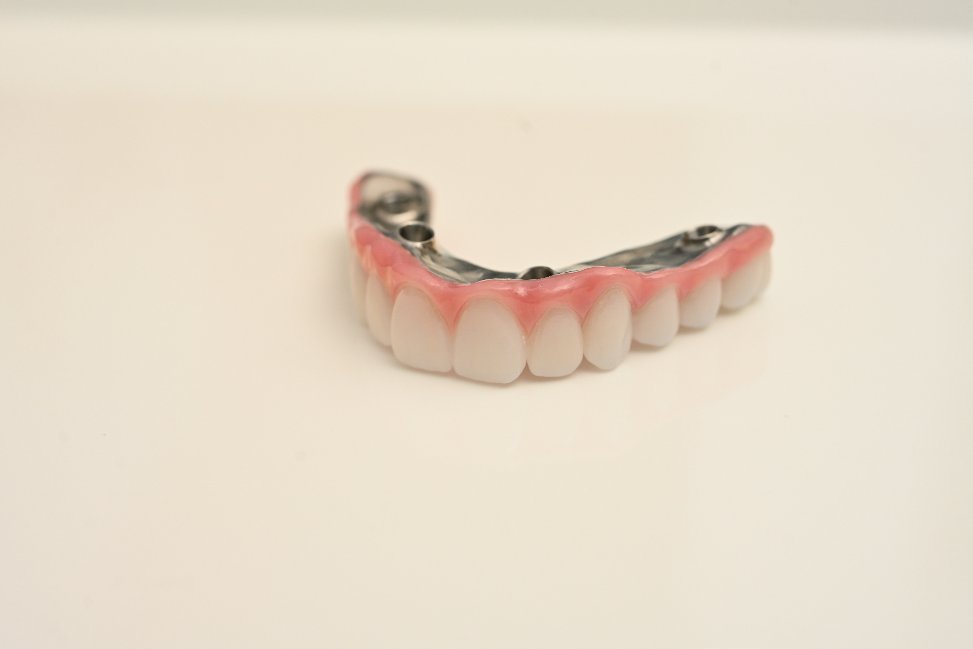 Implant supported bridge with titanium bar