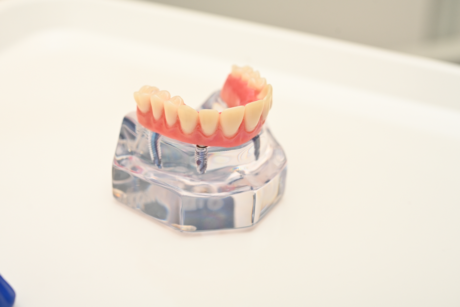 Titanium dental implant placed in the jawbone